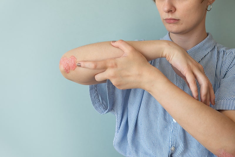 <a href="https://shreedhruti.midbridgetechnologies.com/psoriasis-2/" class="txt">Psoriasis</a>