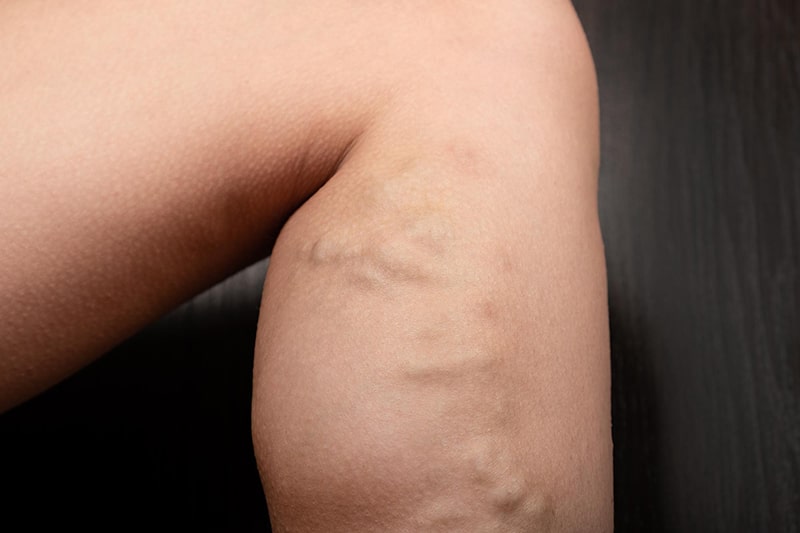 <a href="https://shreedhruti.midbridgetechnologies.com/varicose-veins-2/" class="txt">Varicose-veins</a>